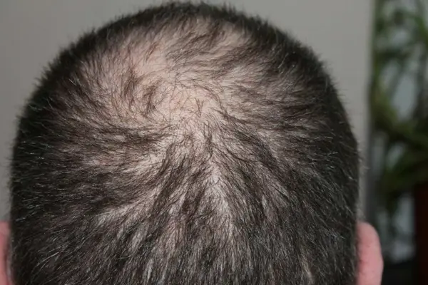 Alopezie (Haarausfall)