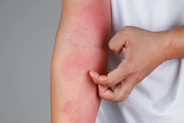 Ekzem (atopische Dermatitis)