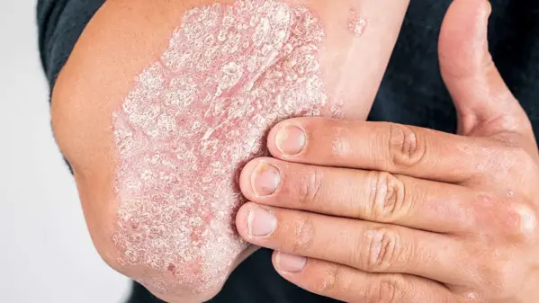 Schuppenflechte (Psoriasis)