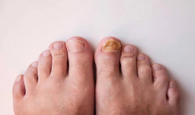 Behandlung von Nagelpilz